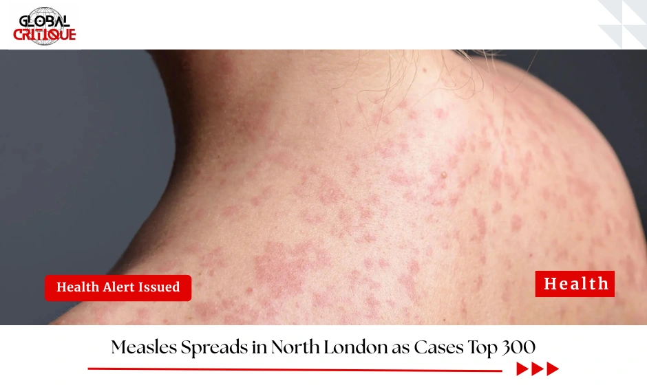 Measles Spreads in North London as Cases Top 300